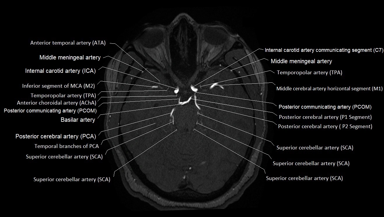 MRA brain (cerebral arteries) anatomy axial 3T image 14.webp